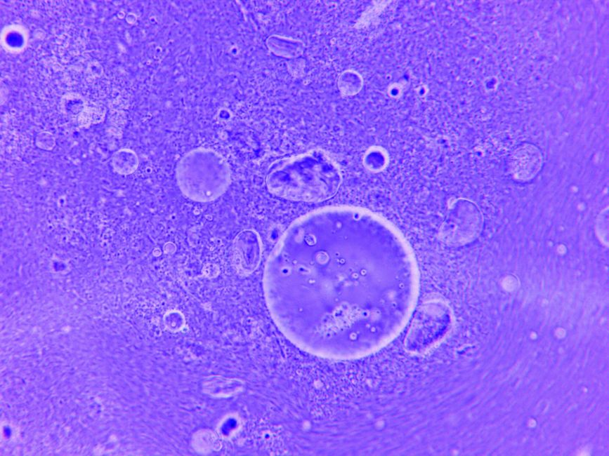 what is entamoeba histolytica causes symptoms treatment