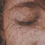 what is lentigo maligna melanoma causes treatment