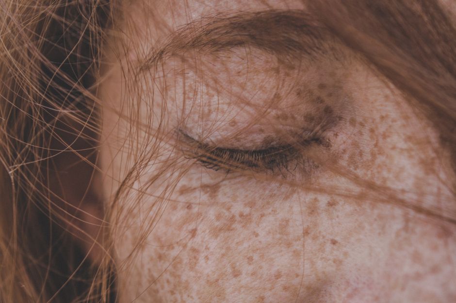 what is lentigo maligna melanoma causes treatment