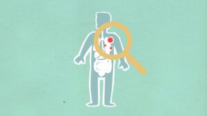 What Is Macrophage Activation Syndrome? Key Facts 7 what is macrophage activation syndrome