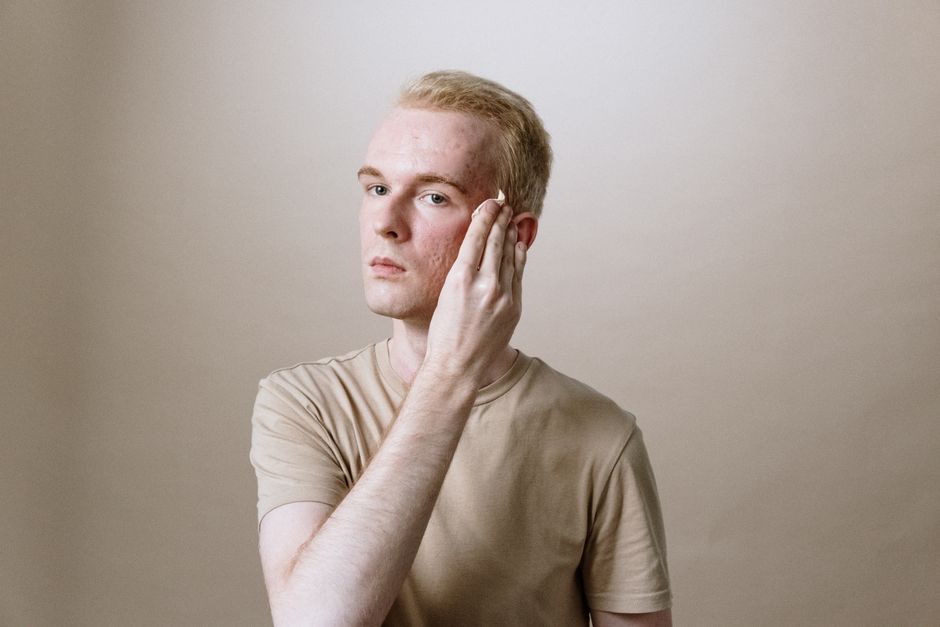what really dries out acne without making it worse