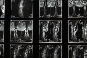 when should i see a neurologist for sciatica
