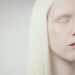 why do albinos eyes shake