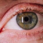 why is my iris not round causes of an irregular pupil