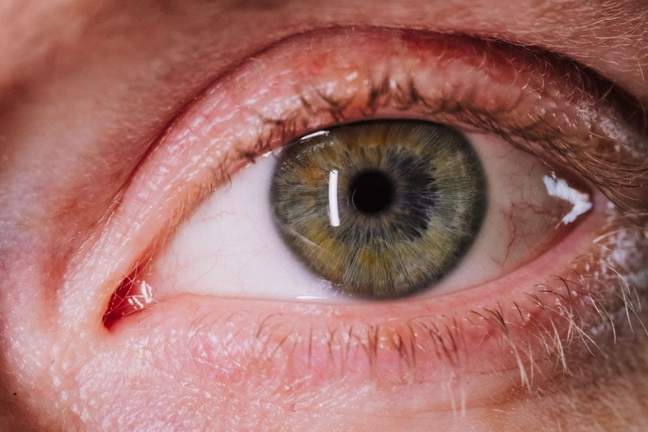 why is my iris not round causes of an irregular pupil