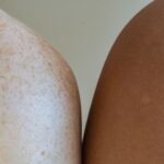 why is my skin darker after microneedling causes fixes