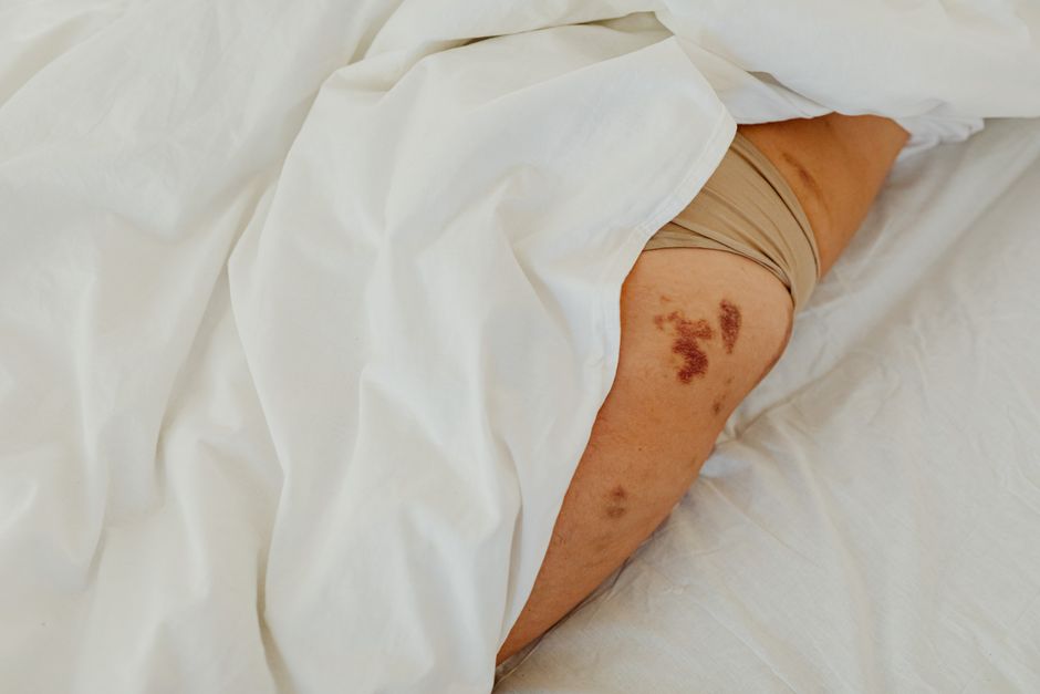 can shingles be on both sides of the body