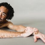 can vitiligo go away