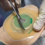 how a colostomy bag works stoma pouch skin barrier