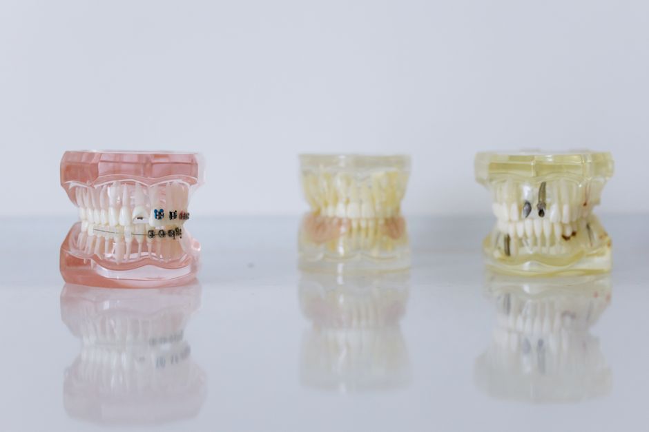 how do braces work from brackets to retainers