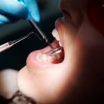 how do dentists check for cavities methods explained