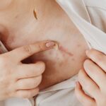 how to know if you have a keloid or piercing bump