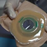 how to live with a colostomy bag tips for daily life