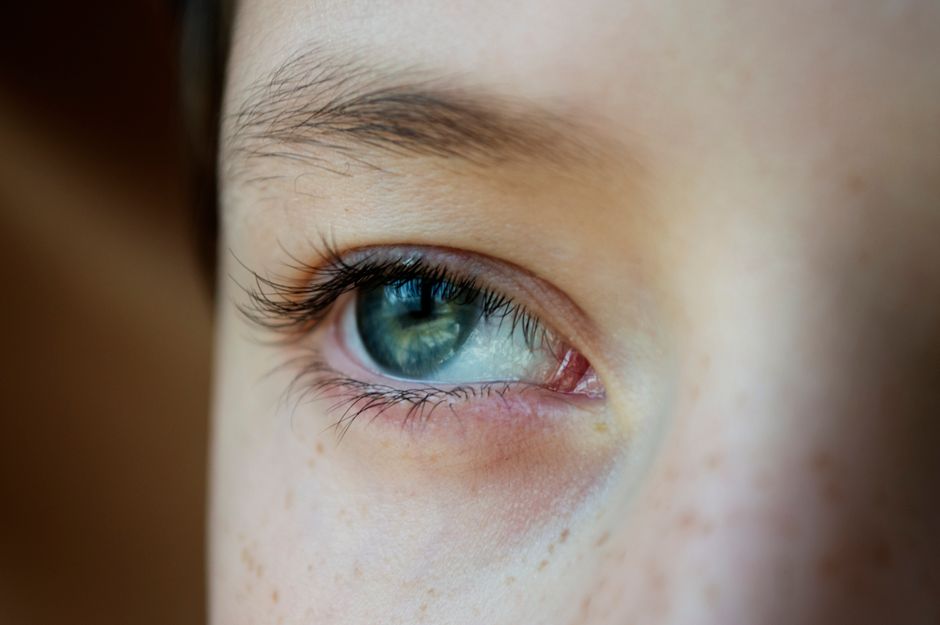 how to prevent conjunctivitis from spreading
