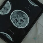 neuropathy a neurological disorder