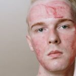 what can cause rosacea skin gut and lifestyle factors
