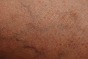 What Do Varicose Veins Look Like? 3 what do varicose veins look like