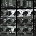 what is a dexa scan for bone density body composition