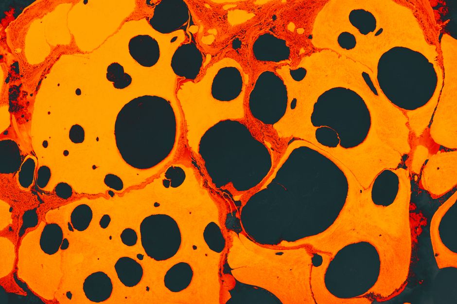 what is acute interstitial nephritis causes treatment