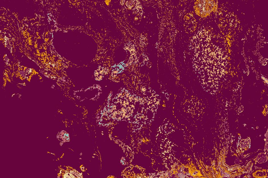 what is cd31 staining and how is it used in diagnosis