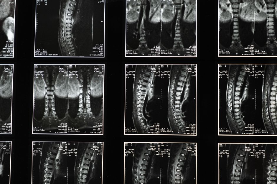 what is lumbarization causes symptoms diagnosis