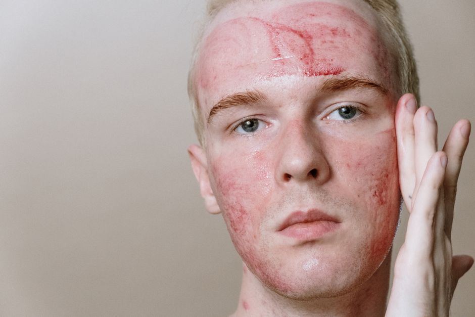 when should you see a dermatologist for acne
