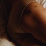 how to heal chafed thighs remedies and prevention