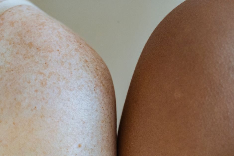 what makes skin darker or lighter causes explained